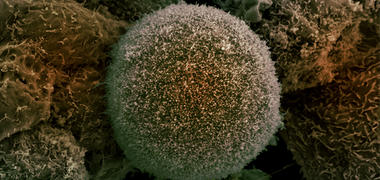 A microscope image of a prostate cancer cell