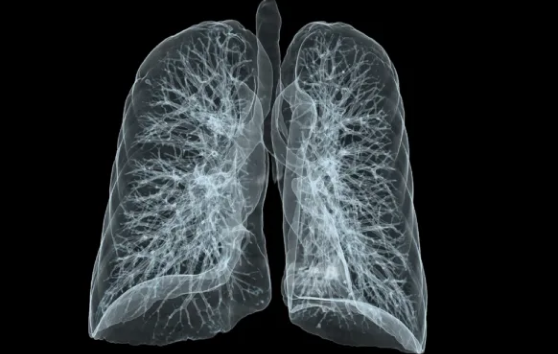 An x ray of a pair of lungs