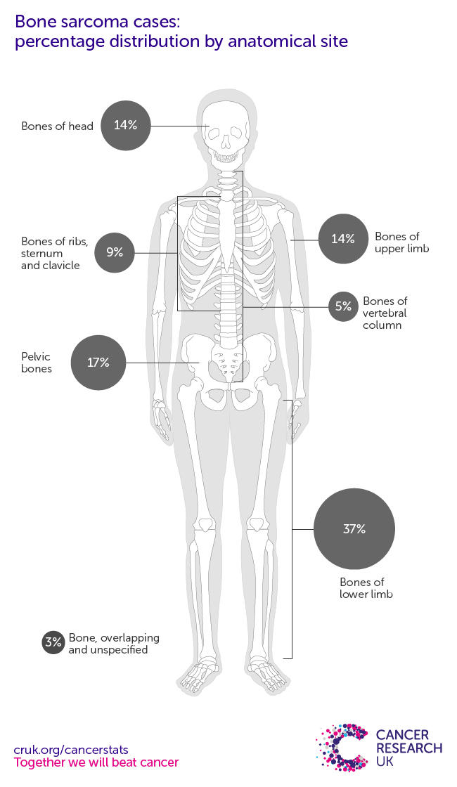 A infographic showing the most common specific location for bone sarcomas in the UK is the lower limb (2016-2018).