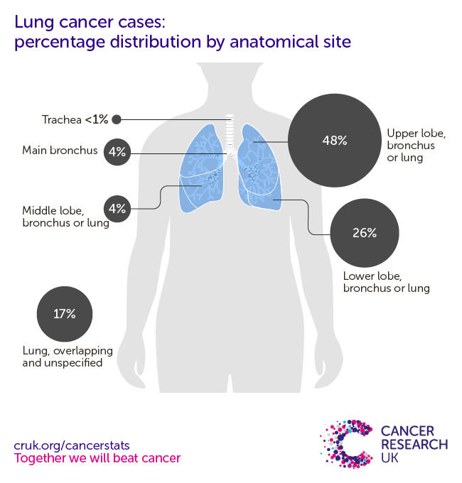 a infographic showing the most common specific location for lung cancers in the UK is the upper lobe of the bronchus or lung (2016-2018).